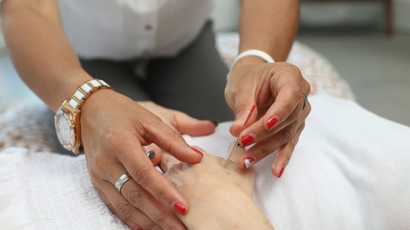 A close-up of an acupuncture treatment session